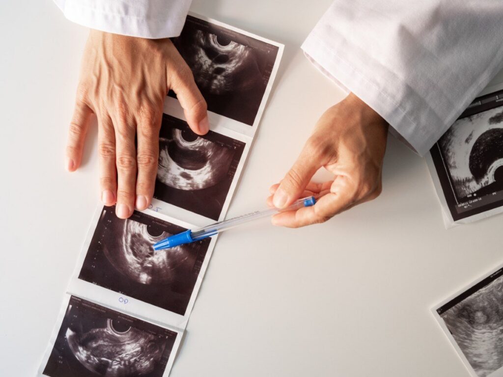 Nuovi studi esplorano legami tra PMOS e demenza